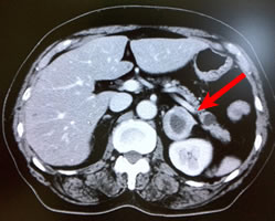 造影CT ←部が副腎腫瘍